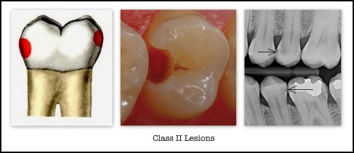 Class 2 Caries Lesions 