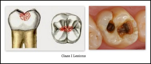 Class 1 Caries Lesions