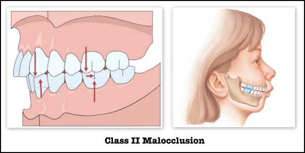 class II maloccusion