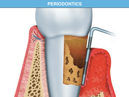 Periodontics