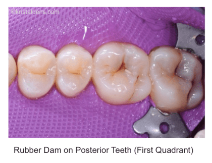 Complete rubber dam isolation 