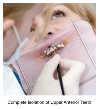 Rubber dam isolation 