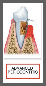 ADVANCED PERIODONTITIS