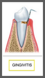GINGIVITIS