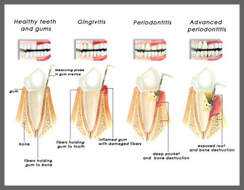 gingivitis periodontitis