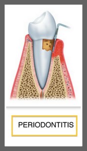 PERIODONTITIS
