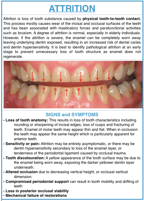 dental attrition